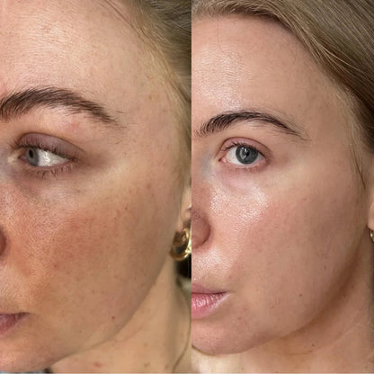 Glutathione Dark Spot Patches