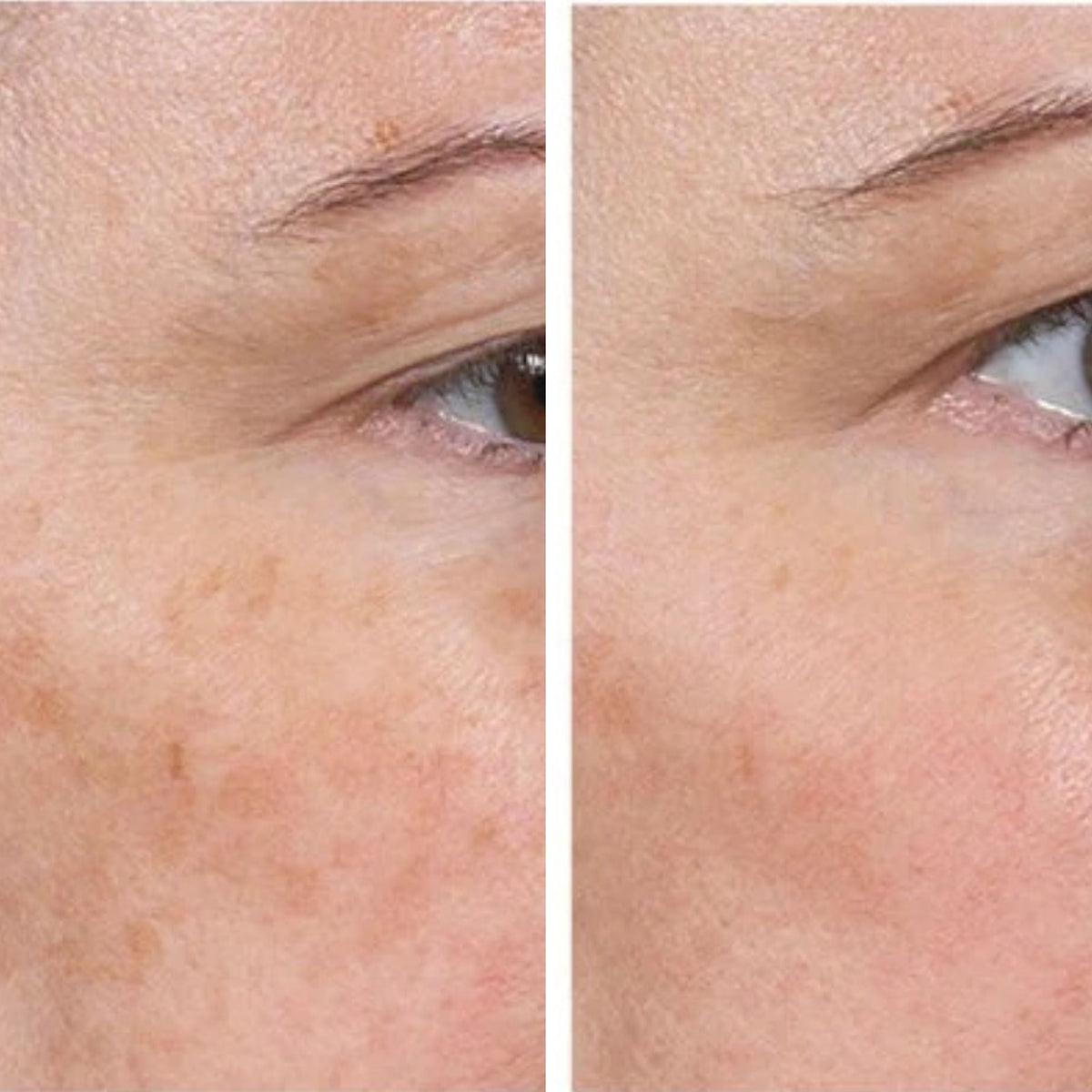 Glutathione Dark Spot Patches