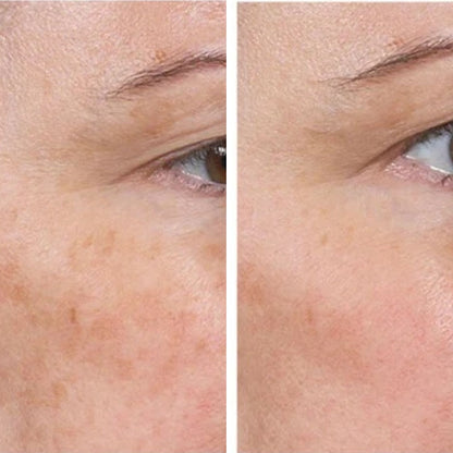 Glutathione Dark Spot Patches